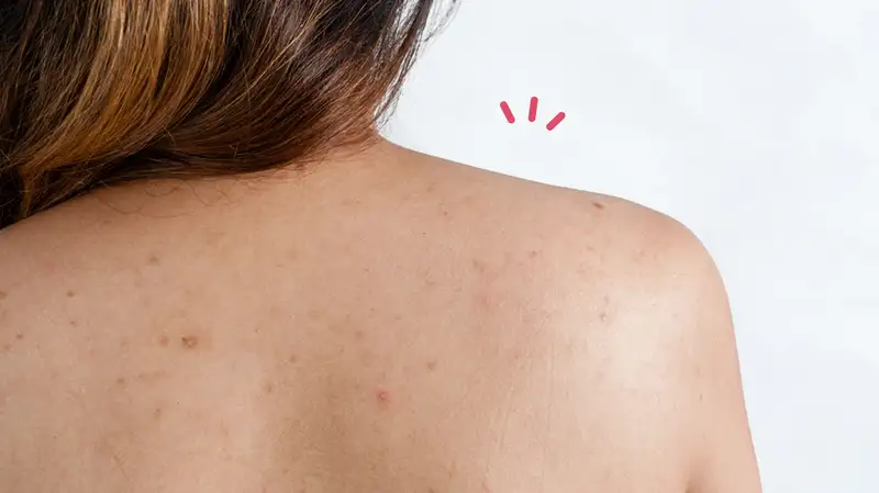 merawat kulit punggung