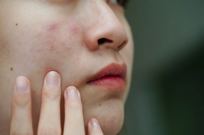 Cara Memperbaiki Skin Barrier yang Rusak