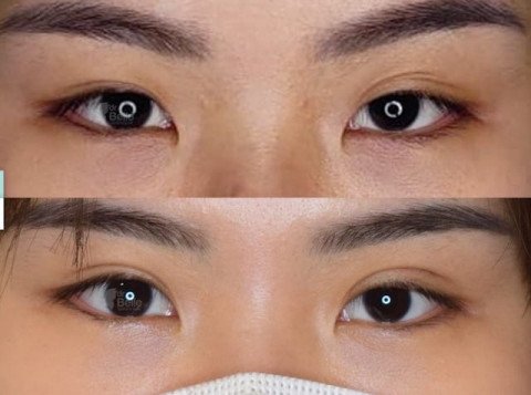 Eyelid Clipper: