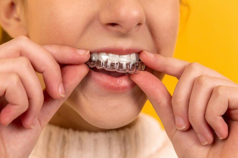 Enameloplasty:
