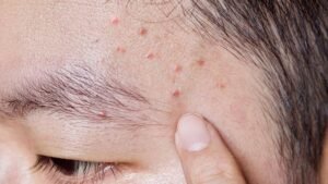 Tips Mengatasi Jerawat Puber Remaja agar Kulit Tetap Sehat