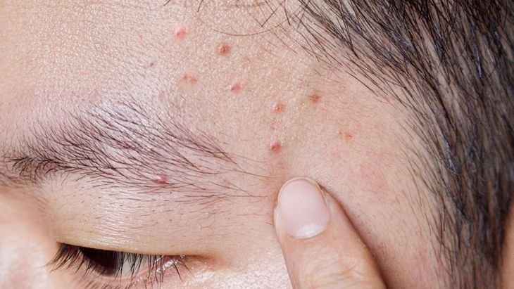 Tips Mengatasi Jerawat Puber Remaja agar Kulit Tetap Sehat