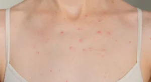 Dada Berjerawat? 